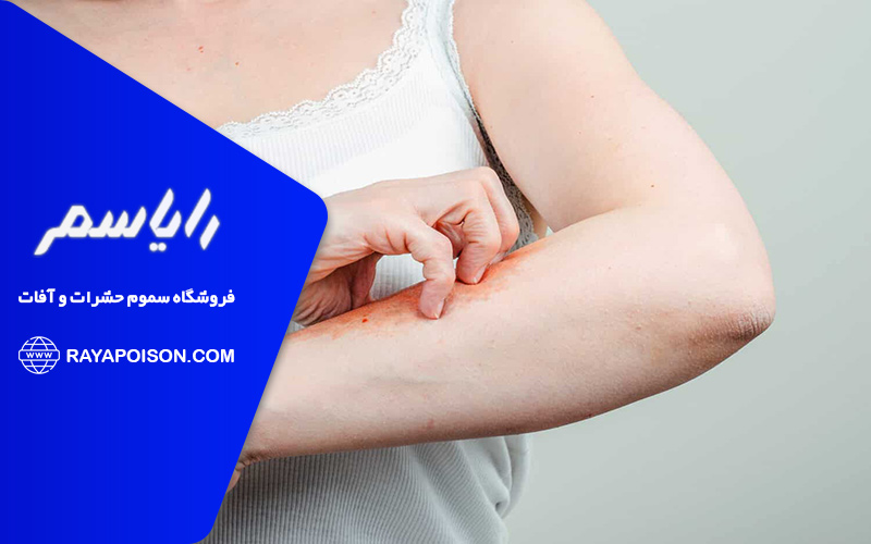 درمان خانگی گزش کک