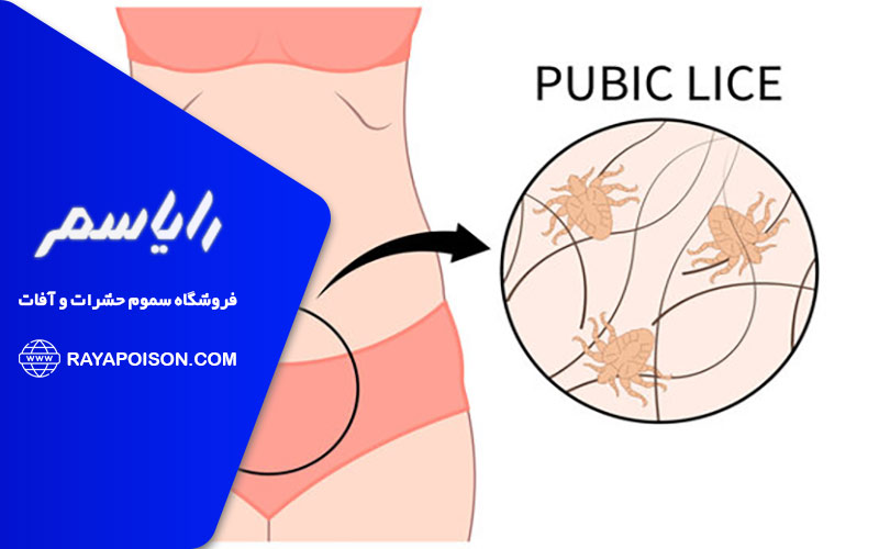 علائم وجود شپش در نواحی مختلف بدن